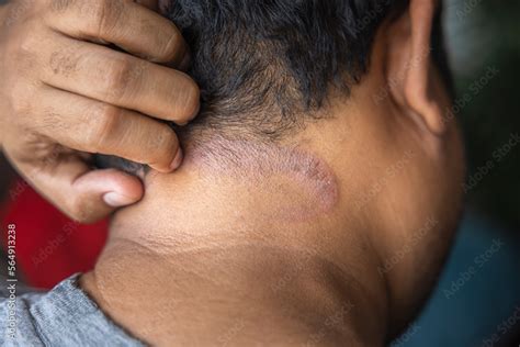 Dark Skinned Asian Men Suffer From Scalp Dermatitis Due To Moisture Causing Fungi Fungal