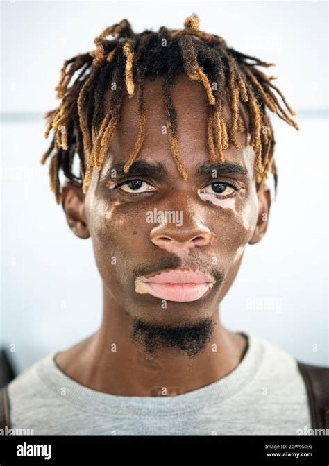 African American Black Young Man With Vitiligo Skin Stock Photo Alamy