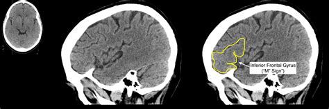 Radiological Anatomy Inferior Frontal Gyrus Stepwards