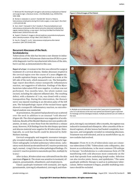 Pdf Recurrent Abscesses Of The Neck