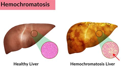 Hemochromatosis Causes Gene Symptoms Diet And Treatment