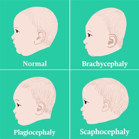 Plagiocephalyflat Head Syndrome Flat Head Syndrome Baby Head Shape