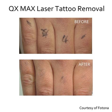 Laser Tattoo Removal Before And After Care Juliette Hardman