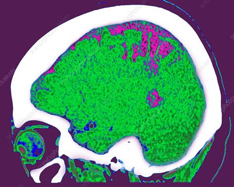 Cerebral Atrophy Ct Scan Stock Image C0254464 Science Photo Library