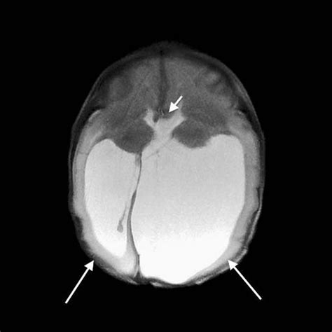 Axial T2 Fast Spin Echo Magnetic Resonance Image Of The Brain