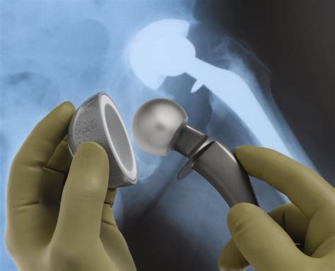 Hip Replacement Surgery What To Expect On The Day Of Surgery
