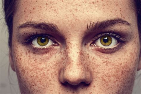 Freckle Challenge Goes Viral On Social Media