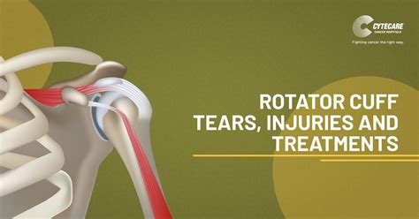 Rotator Cuff Tears Injuries And Treatments Cytecare Hospitals