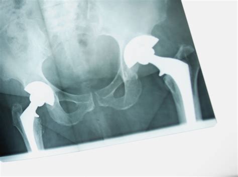 Johnson And Johnson Recalls 7500 Adept Hip Implants Second Recall In