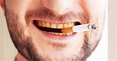 effects of smoking on teeth