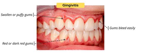 Gingivitis Vs Periodontitis Share Dental Care