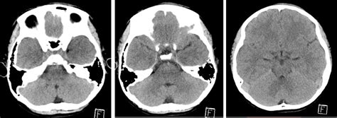 Linear Skull Fracture Radiology Cases