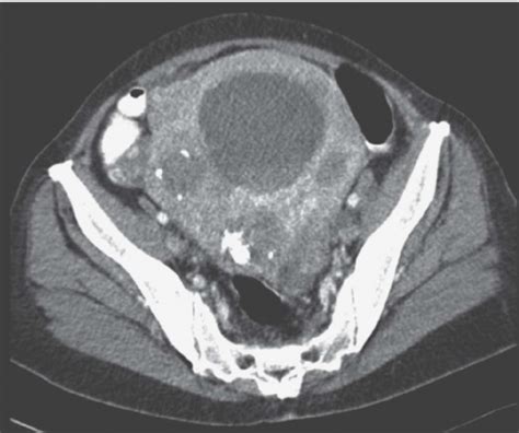 Diseases Of The Uterus Radiology Key