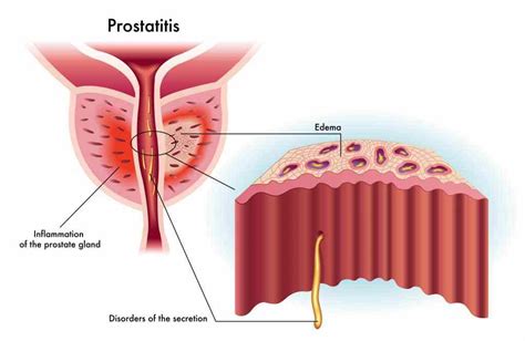 Prostatitis Symptoms Causes Treatment