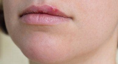 Can You Get Heat Rash On Your Lips Lipstutorial Org