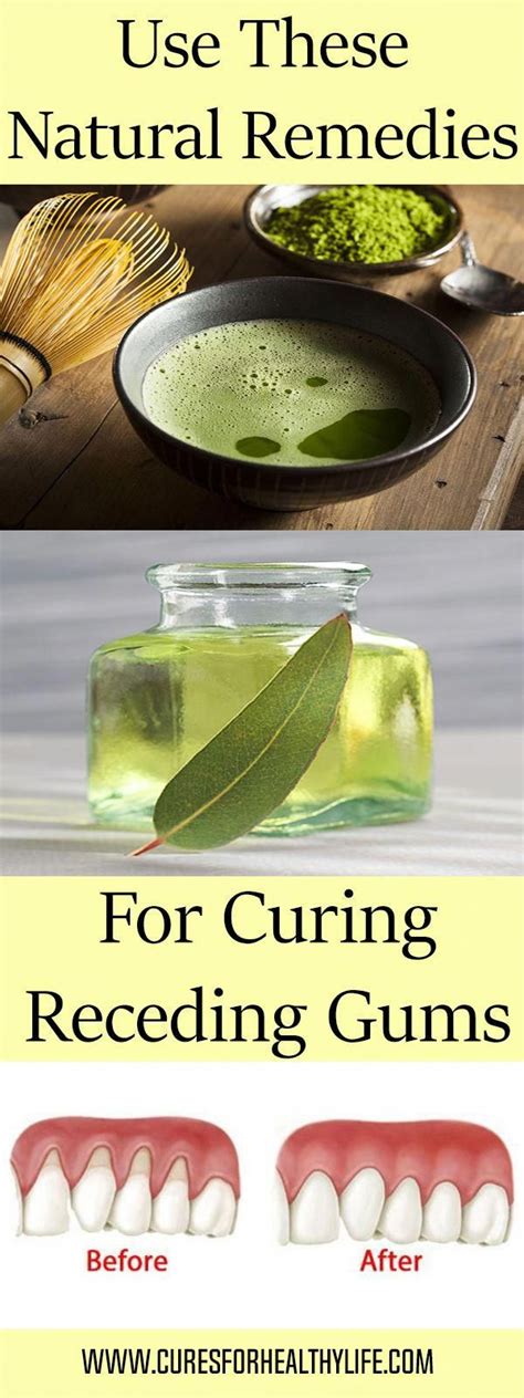 Use These 4 Natural Remedies For Curing Receding Gums