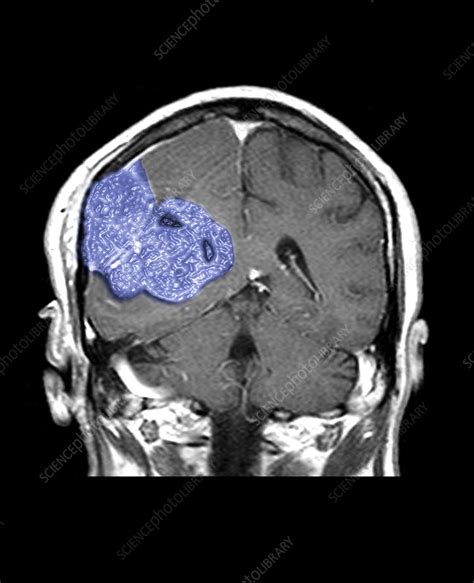 Mri Of Malignant Brain Tumor Stock Image C0047452 Science Photo