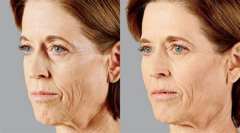 Face Fillers Before And After Photos Dailymigrants Com