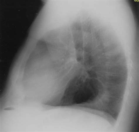 Hiatal Hernia On Chest X Ray X Rays Case Studies Ctisus Ct Scanning