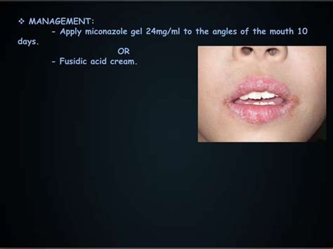 Oral Pathology Fungal Infections 2