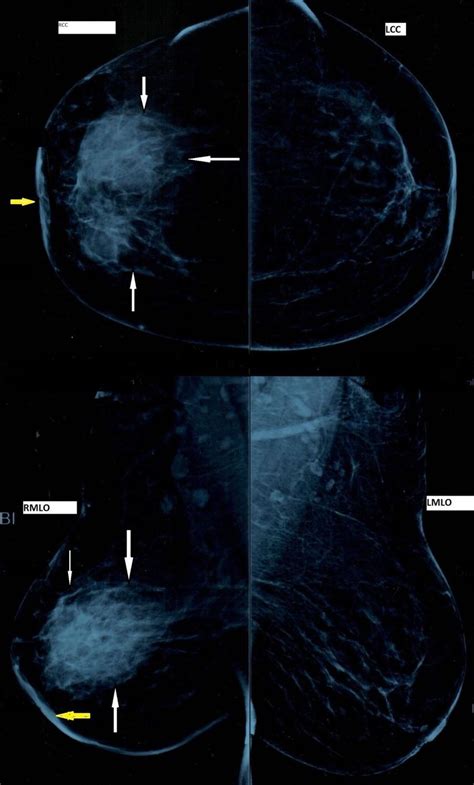 Mammogram Showing Ill Defined Irregular Opacity In Right Breast Black