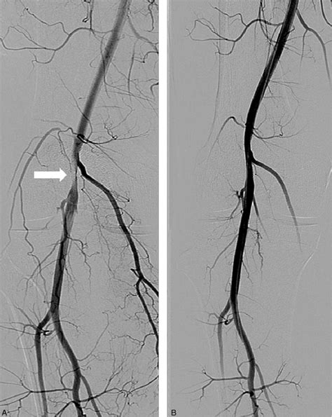 Digital Subtraction Angiography Of The Right Popliteal Artery A