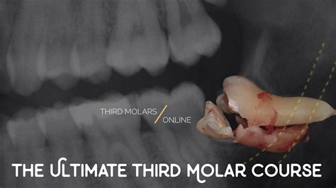 The Ultimate Surgical Third Molar Extraction Course Online Course Karma