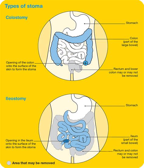 How To Change A Colostomy Bag Diagram Diagram Resource Gallery