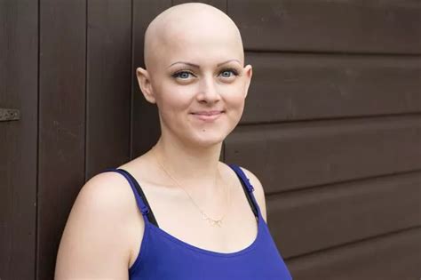 Beautiful Hairstylist With Alopecia Reveals Bald Head For First Time In 20 Years After Lifetime