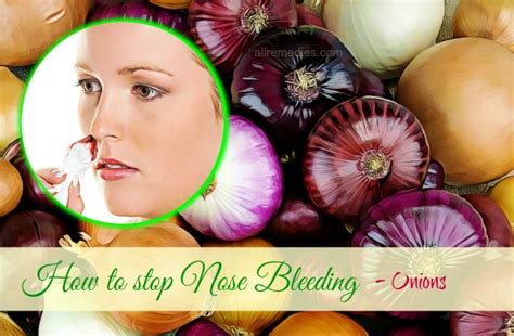 Top 14 Natural Home Remedies How To Stop Nose Bleeding Instantly