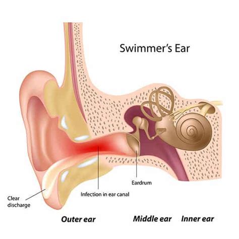 Acute Otitis Externa Miami Ent Doctors Ear Nose Throat Specialists