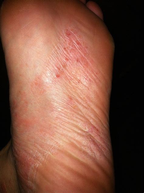 Rash Eczema On The Soles Of My Feet Started At The Sides Of My Feet But Seem To Have Migrated