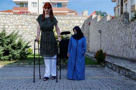 World S Tallest Woman Gelgi Is Suffering From Weaver Syndrome