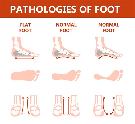 Foot Pathologies Infographic Flat Foot Anatomy Deformed Bradford