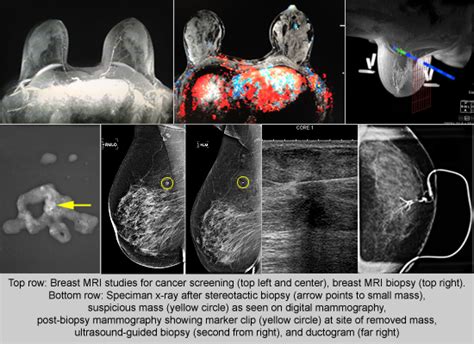 Diagnostic Mammogram Procedure