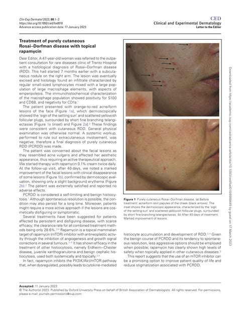 Pdf Treatment Of Purely Cutaneous Rosai Dorfman Disease With Topical
