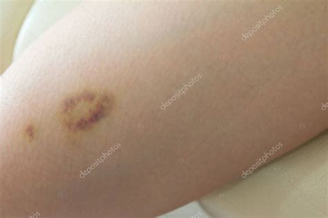 Closeup Bruise On Wound Woman Leg Skin Stock Photo By ©thaneehgmail
