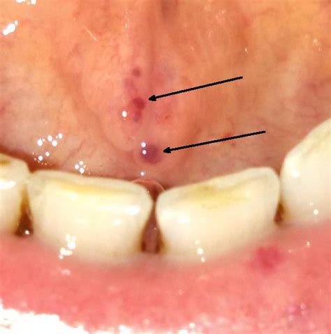 Dark Spot In Mouth Pictures Photos
