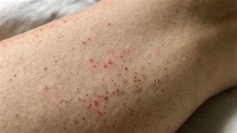 How To Cure Razor Burn On Legs Flatdisk24