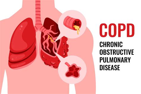 Copd Symptomen Hot Sex Picture