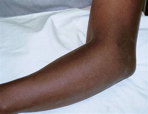 Elbow Dislocation Pediatric Pediatrics Orthobullets