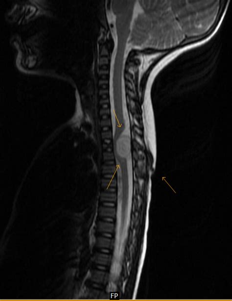 Dorsal Dermal Sinus With Epidural Abscess Mri Sumers Radiology Blog