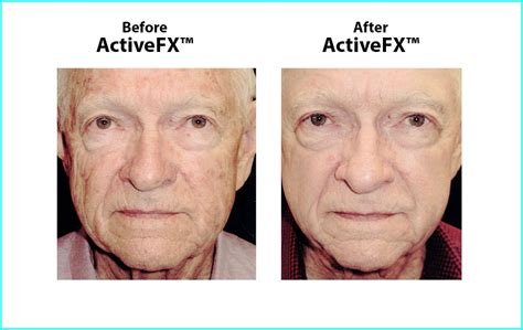 Activefx Deepfx And Totalfx Laser Treatments Austin Tx Ctd