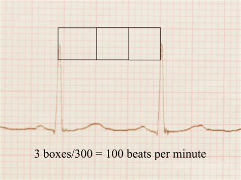 How To Read An Ekg 9 Steps With Pictures Wikihow