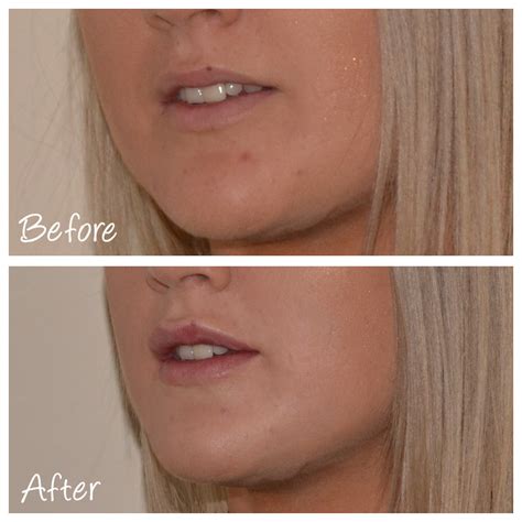 Albums 93 Images Lip Filler Before And After Pics Latest 122023