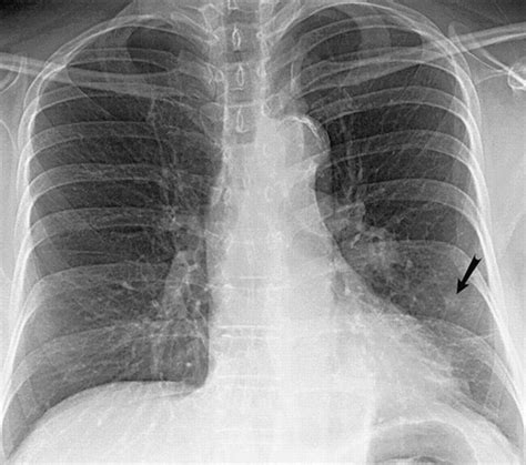 Effects Of Radiation Therapy On The Lung Radiologic Appearances And