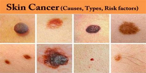 Different Kinds Of Skin Cancer