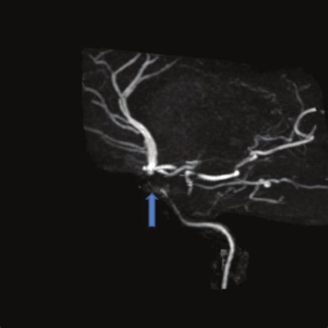 MRA Head Showing A Right Intracranial Internal Carotid Artery Stenosis