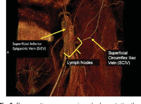 Pdf The Use Of Magnetic Resonance Angiography In Vascularized Groin