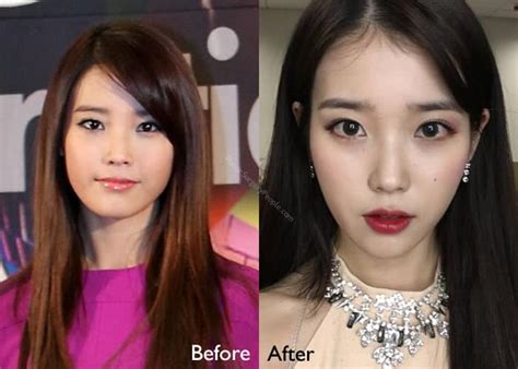 Iu Plastic Surgery Before And After Photos Plastic Su